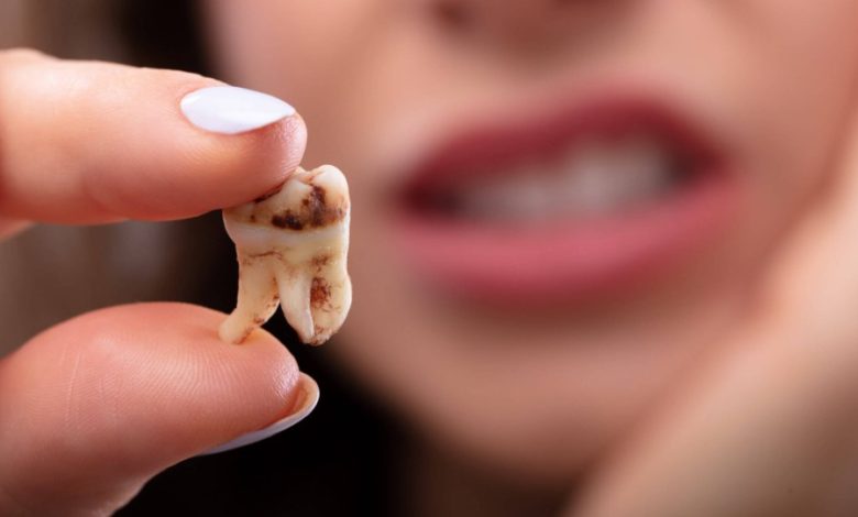اعراض تسوس الأسنان ومتى يجب زيارة الطبيب؟