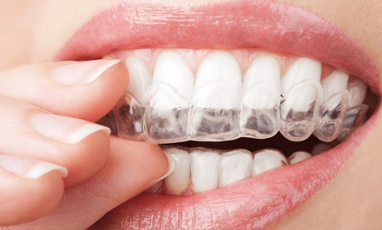 تقويم الأسنان الشفاف