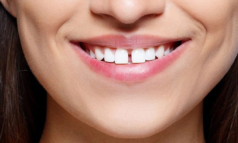 سد فراغات الأسنان بالليزر .. ما هي المميزات والعيوب؟