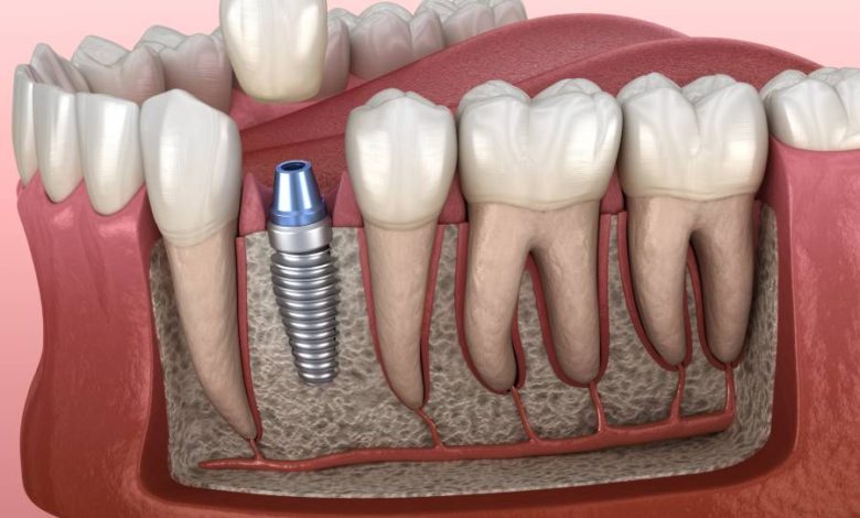 كيف تتم عملية زراعة الأسنان