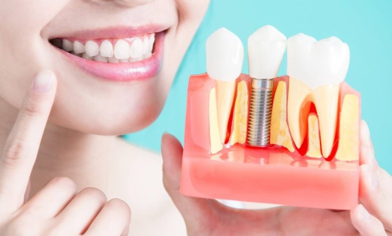 ما هي زراعة الأسنان