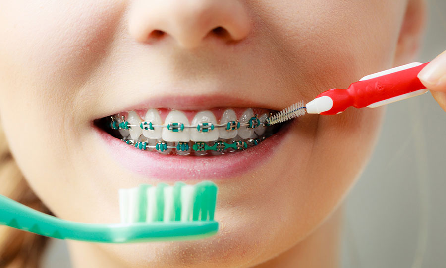 Hvordan rense tenner med tannregulering