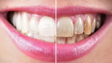 تغير لون الأسنان